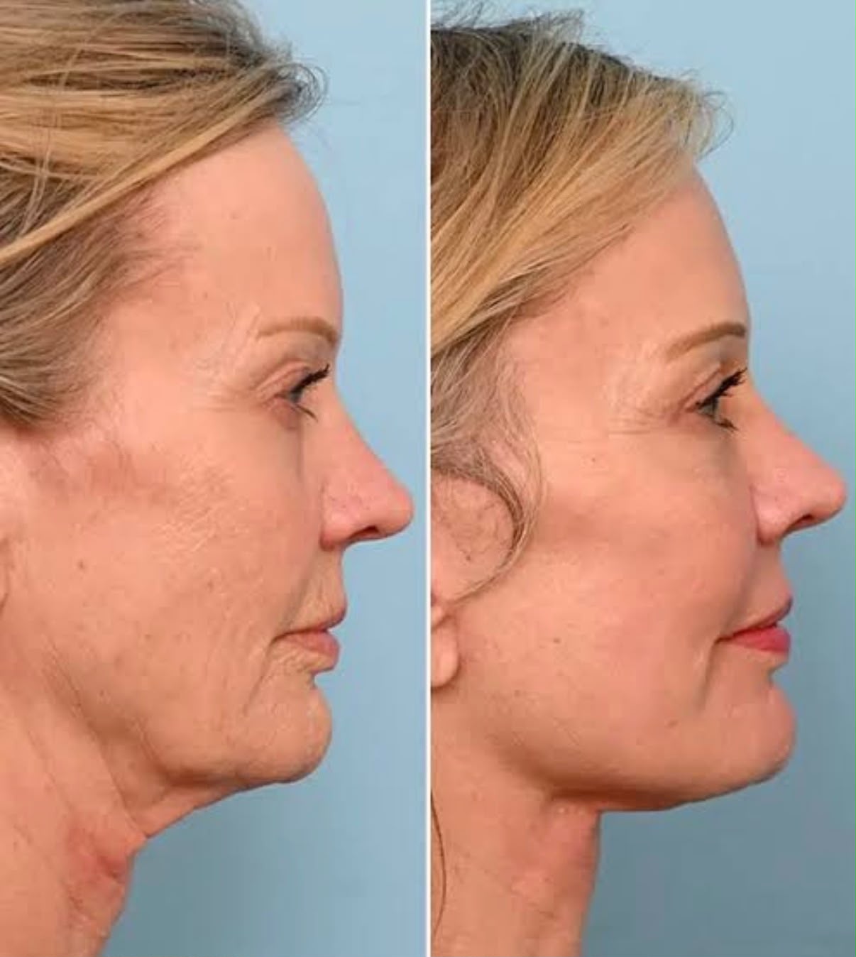 Woman in right profile against a blue background before and after facial fat transfer by Dr Mario Goisis