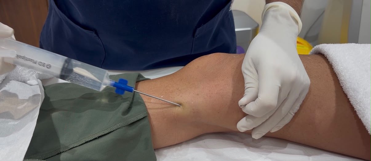 Fat being collected from Becky’s knee through a fine cannula during her own fat-grafting treatment